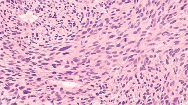 Kanker Jaringan Lunak, Kenali Gejala, Penyebab, dan Penanganannya - Alodokter