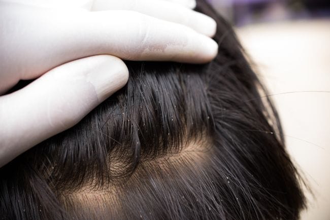 Cara Menghilangkan Kutu Rambut dengan Garam, Benarkah Efektif? Ini Faktanya - Alodokter