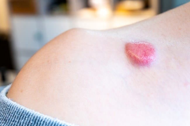 Kanker Kulit Non-Melanoma, Kenali Gejala, Penyebab, dan Tips Pencegahannya - Alodokter