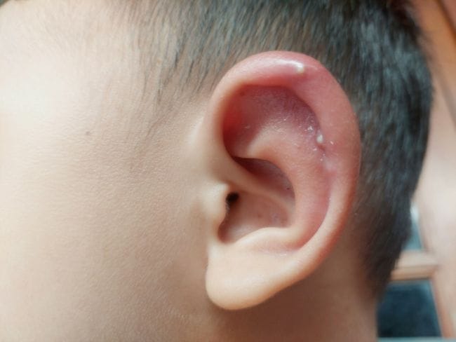 Bisul Di Telinga, Ketahui Penyebab, Cara Mengatasi, dan Pencegahannya - Alodokter