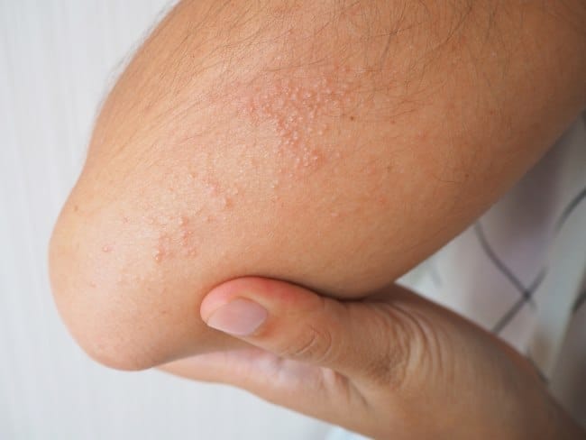 7 Pantangan Biang Keringat agar Cepat Sembuh - Alodokter