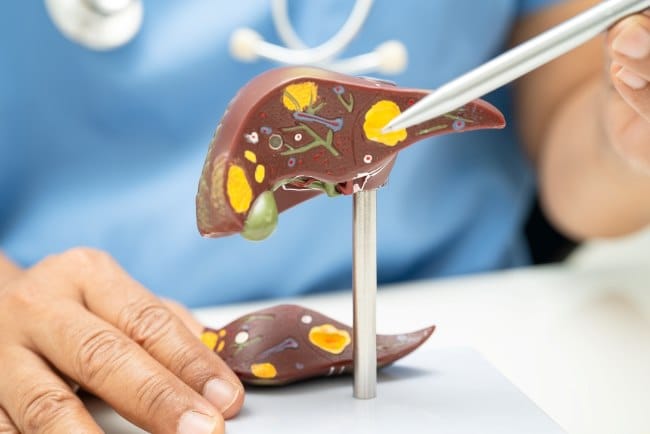 Fatty Liver Grade 3, Kenali Gejala, Penyebab, dan Cara Mencegahnya - Alodokter
