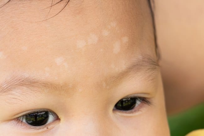 Bercak Putih pada Kulit Bayi, Inilah Berbagai Penyebab dan Cara Mengatasinya - Alodokter