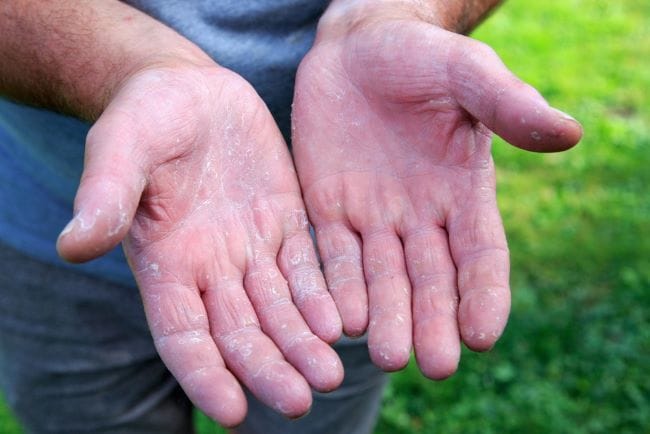 10 Salep untuk Eksim Kering yang Ampuh - Alodokter