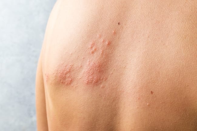6 Salep Herpes di Apotik yang Ampuh - Alodokter