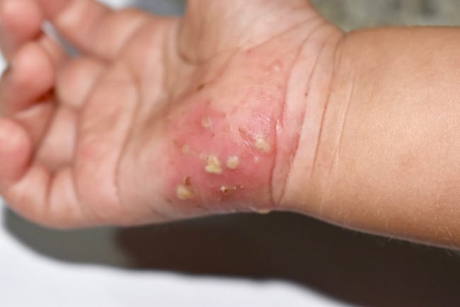 Scabies pada Bayi, Kenali Ciri-Ciri, Penanganan, dan Pencegahannya - Alodokter
