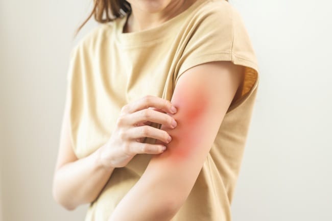 8 Obat Antihistamin untuk Gatal Kulit yang Ampuh di Apotek - Alodokter