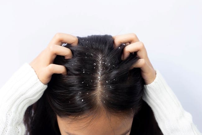 7 Cara Menghilangkan Ketombe yang Cepat dan Efektif - Alodokter