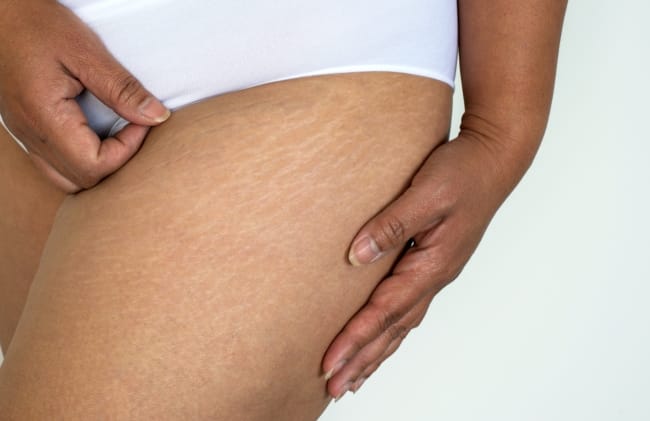 Apakah Stretch Mark Bisa Hilang? Simak di Sini Jawabannya - Alodokter
