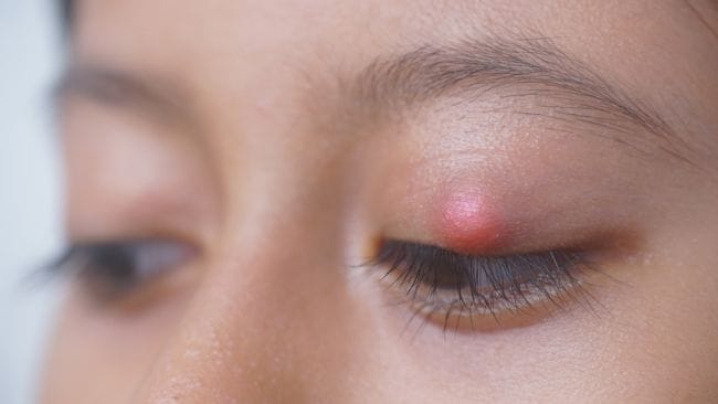 Apakah Bintitan Menular? Ini Penjelasan Medis dan Cara Pencegahannya - Alodokter