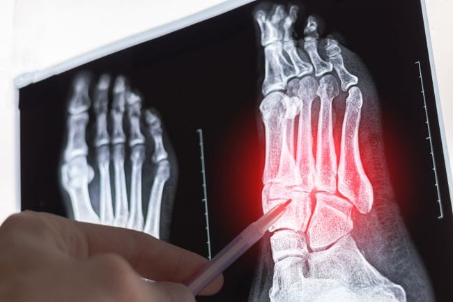 Tulang Metatarsal, Kenali Fungsi serta Cedera yang Dapat Terjadi - Alodokter