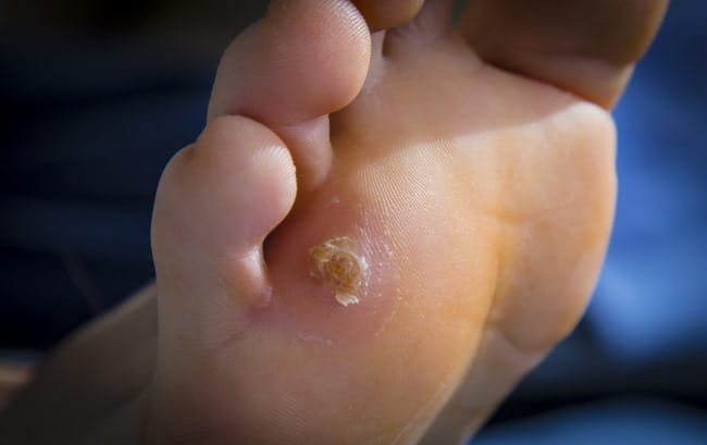 6 Gejala Awal Mata Ikan yang Perlu Diwaspadai - Alodokter