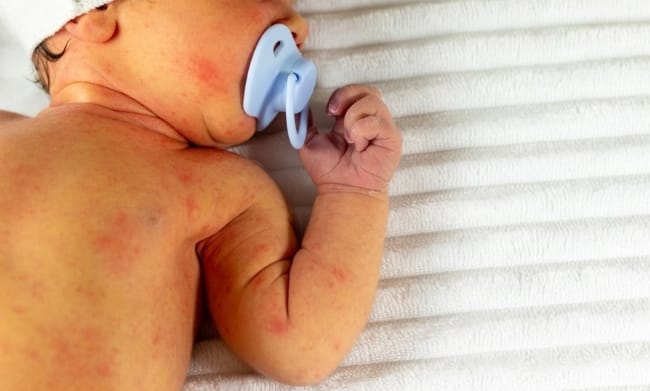 7 Ciri-Ciri Bayi Kuning yang Berbahaya yang Perlu Orang Tua Waspadai - Alodokter