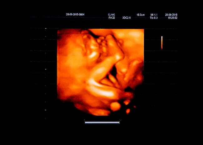 Ketahui Berat Janin Usia 5 Bulan dan Cara Menjaganya agar Tetap Normal - Alodokter