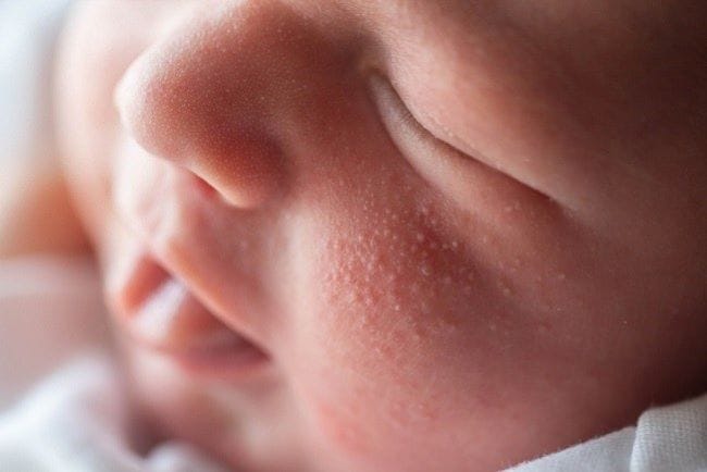 Bintik Putih pada Bayi seperti Nanah, Ketahui Penyebab dan Penanganannya - Alodokter