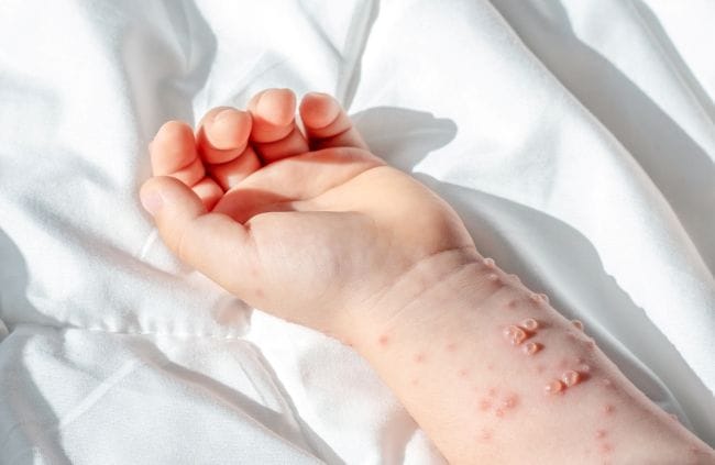 Bentol Berair pada Kulit Bayi: Kenali 8 Penyebab dan Cara Mengatasinya - Alodokter