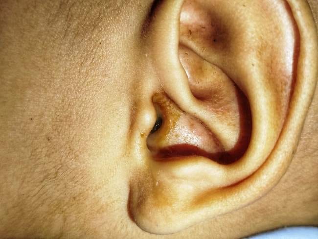 6 Cara Mengobati Telinga Keluar Cairan Seperti Ingus Secara Aman - Alodokter