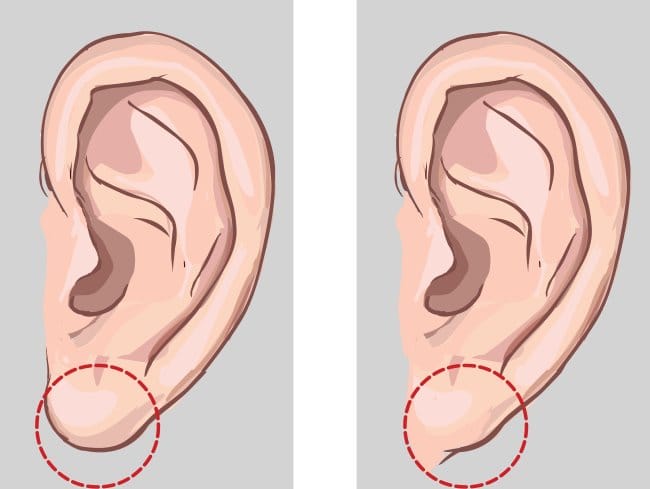Perlekatan Cuping Telinga dan Fakta Dibaliknya - Alodokter