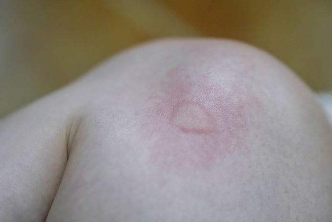 Gatal di Paha dan Bentol Merah, Ini Penyebab dan Tips Mengatasinya - Alodokter