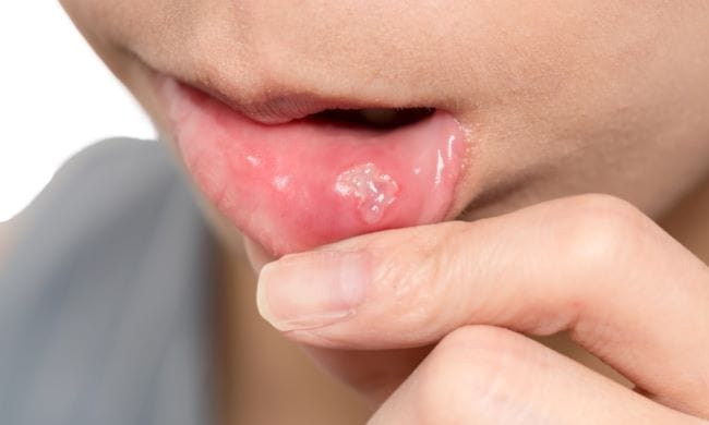 Berapa Hari Sariawan Sembuh? Ini Jawaban dan Cara Mempercepat Penyembuhannya - Alodokter