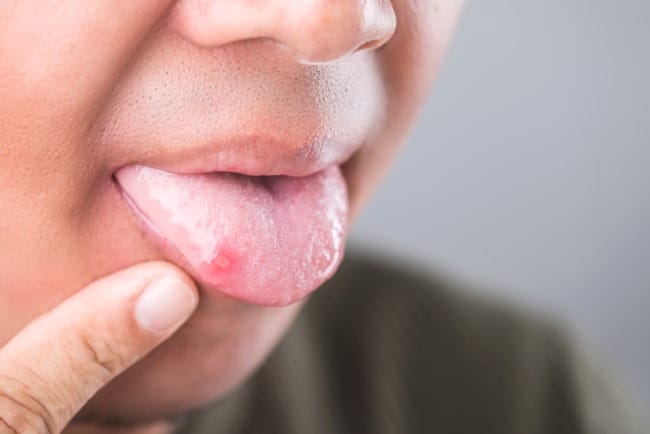 Lidah Sakit, Ketahui Penyebab dan Tips untuk Meredakannya - Alodokter