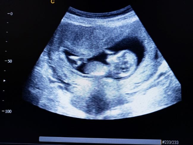 Hasil USG Janin 14 Minggu, Ini yang Akan Terlihat - Alodokter