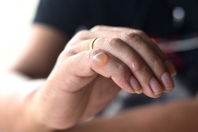 Kulit Melepuh Karena Alergi, Kenali Penyebab dan Cara Mengatasinya - Alodokter