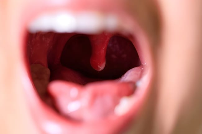 Uvulitis