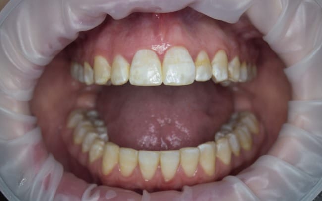 Fluorosis, Kenali Gejala, Penyebab, dan Penanganannya - Alodokter