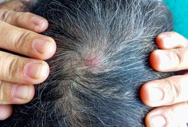 Kulit Kepala Gatal dan Ada Benjolan, Kenali Penyebab dan Cara Mengatasinya - Alodokter