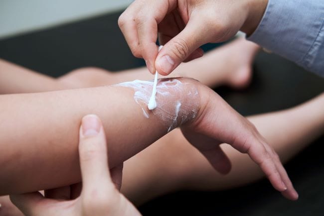 7 Salep Luka Bakar untuk Anak yang Aman dan Efektif - Alodokter