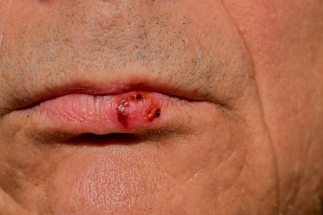 Sariawan HIV Seperti Apa, Ini Penjelasannya - Alodokter