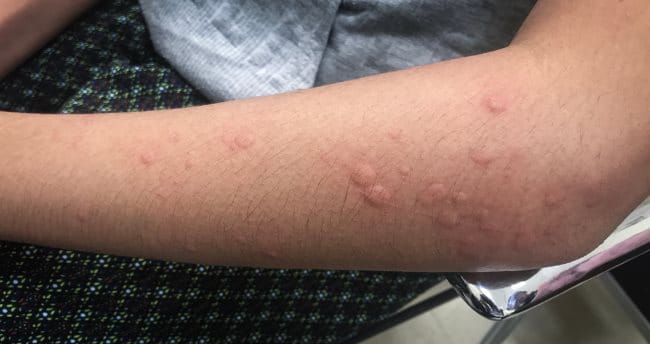 Kenapa Setiap Malam Gatal-Gatal Bentol, Inilah Penyebab dan Cara Mengatasinya - Alodokter