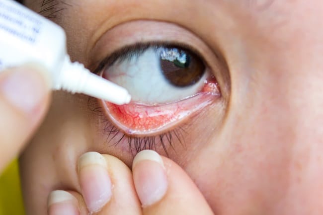 7 Pilihan Salep Mata yang Ampuh Atasi Sakit Mata - Alodokter