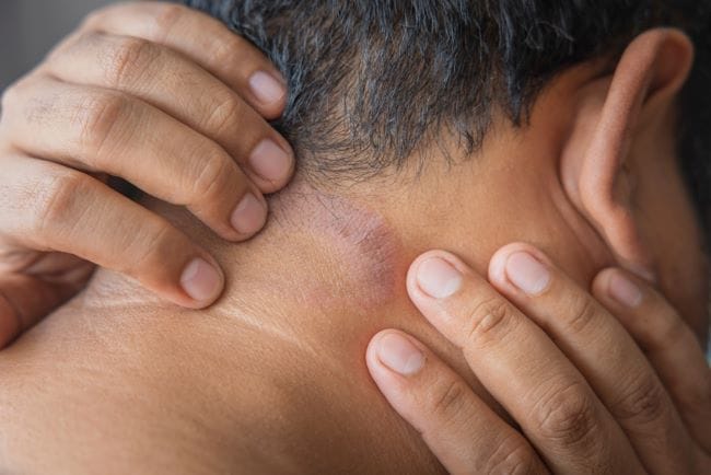 8 Cara Menghilangkan Bekas Gatal yang Menghitam - Alodokter