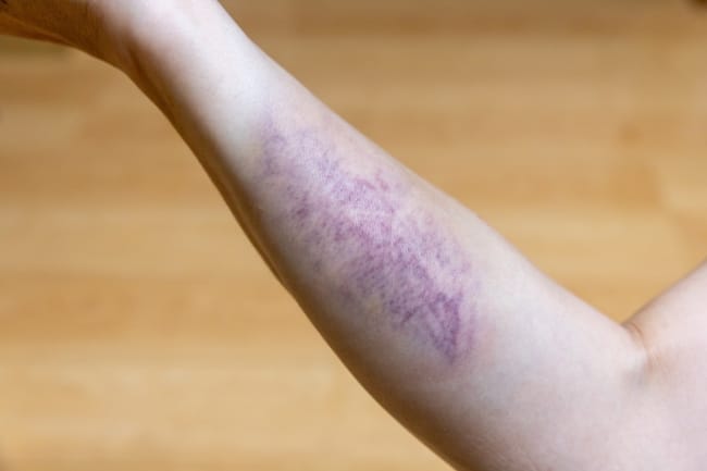 10 Obat Luka Dalam yang Ampuh - Alodokter