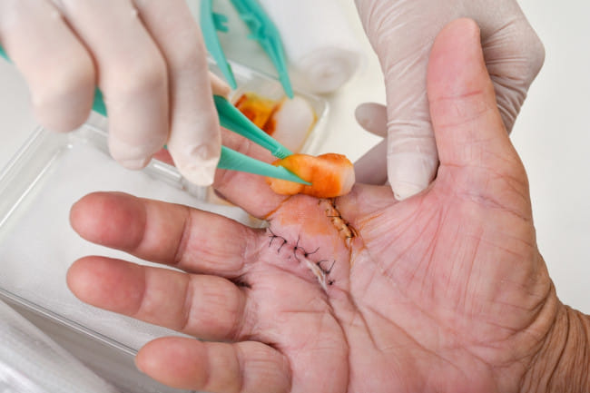 5 Obat Luka Jahitan Cepat Kering yang Mudah Ditemukan - Alodokter