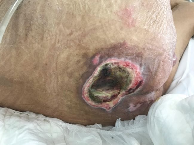 Penyebab Luka Diabetes Menghitam dan Tanda-Tandanya - Alodokter