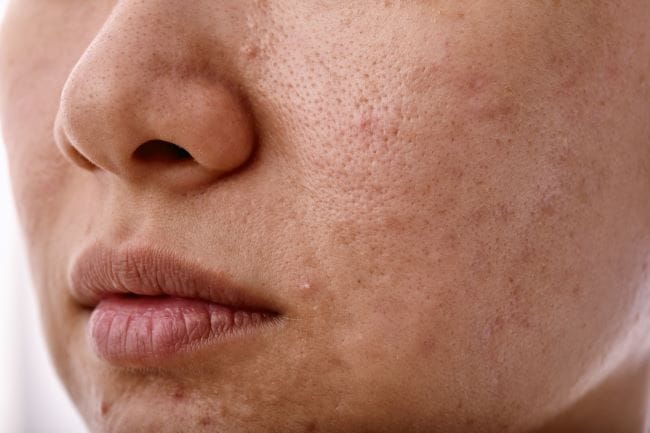 5 Perbedaan Fungal Acne dan Bruntusan yang Wajib Diketahui - Alodokter