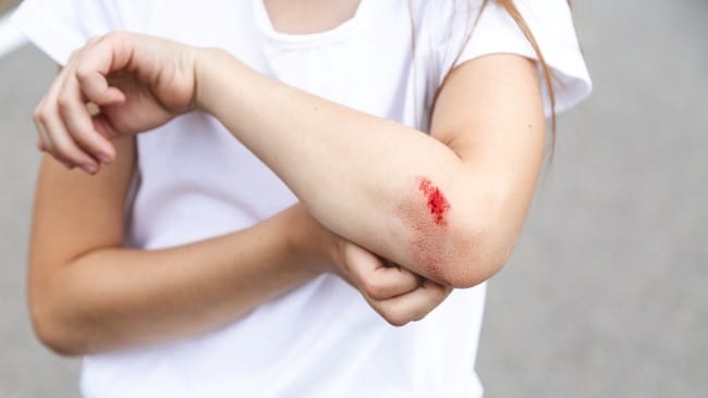 Vulnus Laceratum, Luka Robek yang Tidak Beraturan - Alodokter