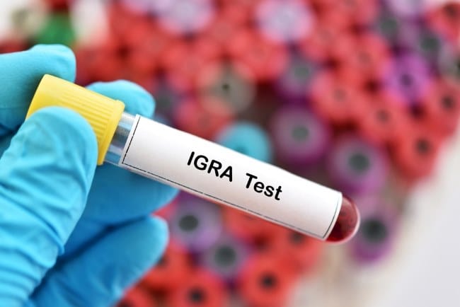 Tes IGRA, Metode Deteksi TBC yang Akurat - Alodokter