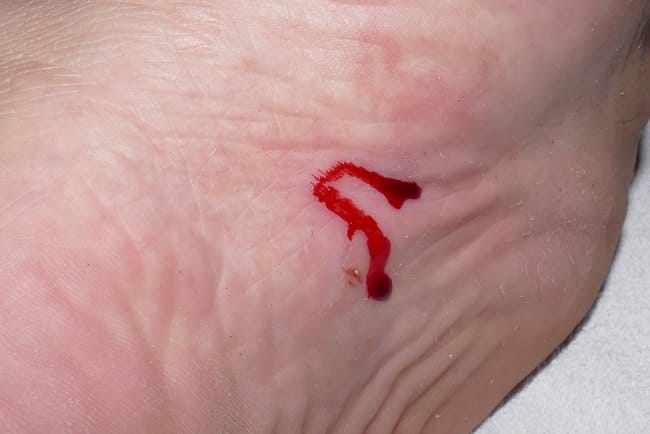 Jiggers, Infeksi Parasit yang Tidak Boleh Disepelekan - Alodokter