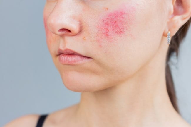 Wajah Penderita Kusta, Ini yang Perlu Diketahui - Alodokter