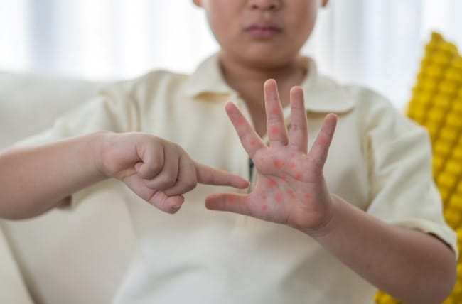 8 Cara Menghilangkan Bintik-Bintik Kecil di Tangan yang Aman - Alodokter