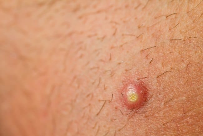 Apakah Bisul Menular? Ini Penjelasan dan Cara Mencegah Penularannya - Alodokter