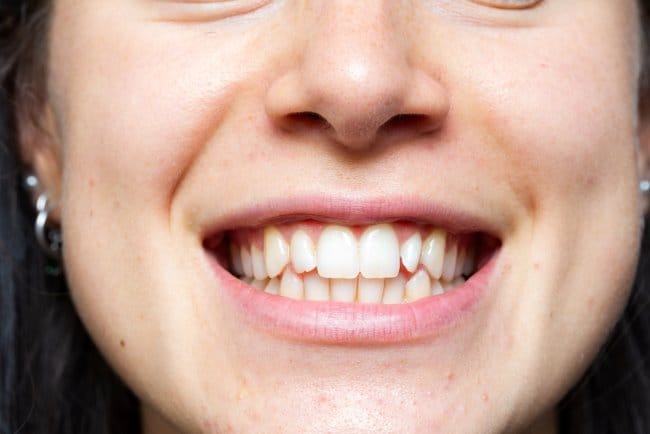 Gigi Kelinci, Kenali Penyebab dan Tips Merawatnya agar Tetap Sehat - Alodokter