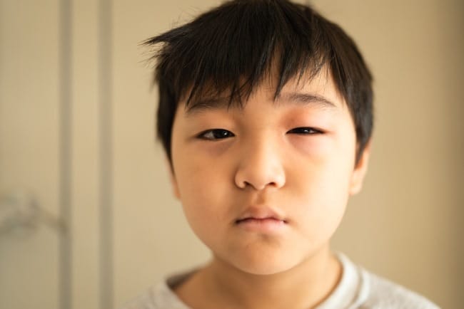 Sindrom Nefrotik pada Anak, Kenali Gejala, Penyebab, dan Penanganannya - Alodokter