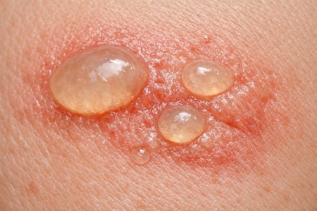 Luka Bakar Menggelembung dan Berair, Ini Penyebab, Risiko, dan Cara Merawatnya - Alodokter