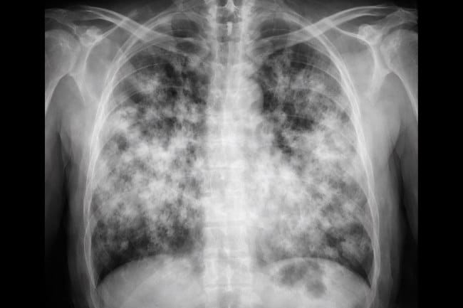 10 Kebiasaan yang Menyebabkan Paru-Paru Basah - Alodokter