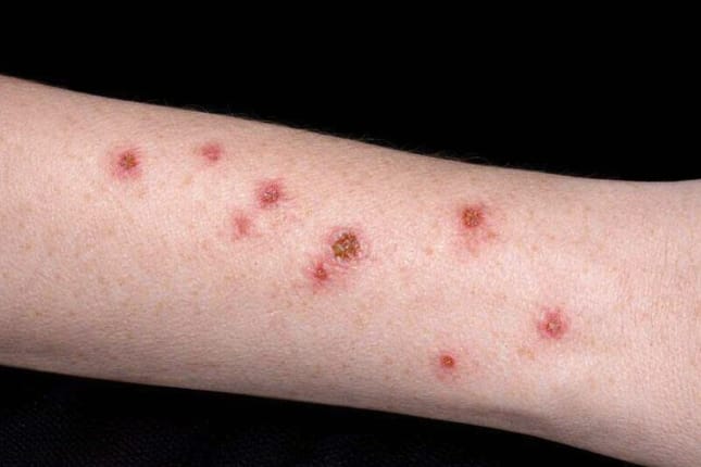 Inilah Ciri-Ciri Darah Manis yang Perlu Dipahami - Alodokter